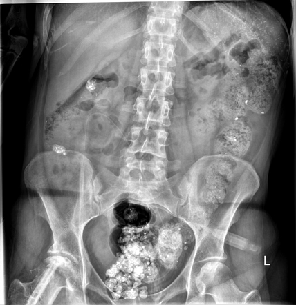 Lanthanum therapy | Radiology Reference Article | Radiopaedia.org