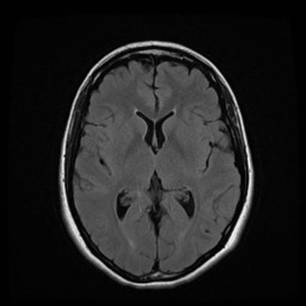 Neurocysticercosis - vesicular and colloidal vesicular | Image ...