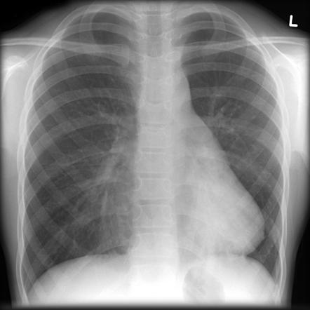 Right middle lobe collapse | Radiology Reference Article | Radiopaedia.org