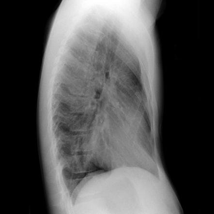 Pectus excavatum | Radiology Reference Article | Radiopaedia.org