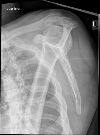 Acromioclavicular joint injury - type V | Image | Radiopaedia.org