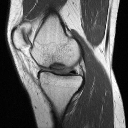 Osteochondritis dissecans | Radiology Reference Article | Radiopaedia.org