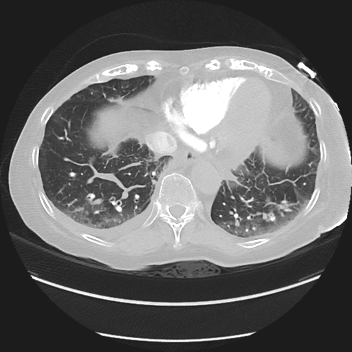 Interstitial Pulmonary Edema Image