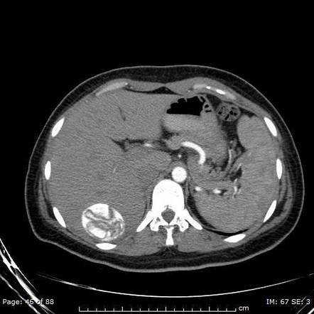 Hepatic hydatid cyst | Image | Radiopaedia.org