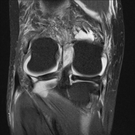 Meniscal root tear | Radiology Reference Article | Radiopaedia.org