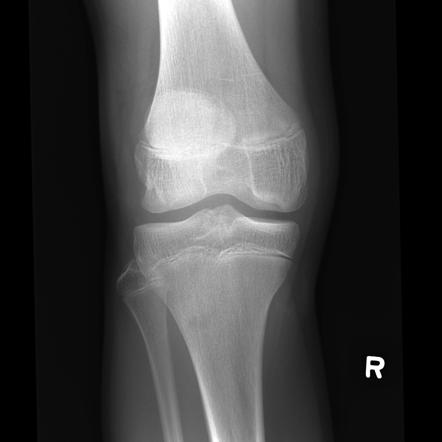 Osteochondritis dissecans | Radiology Case | Radiopaedia.org