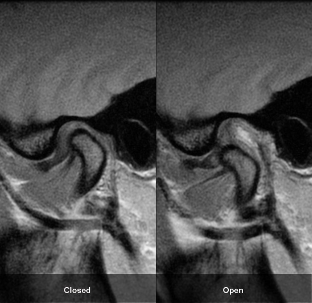 Temporomandibular Joint Dislocation