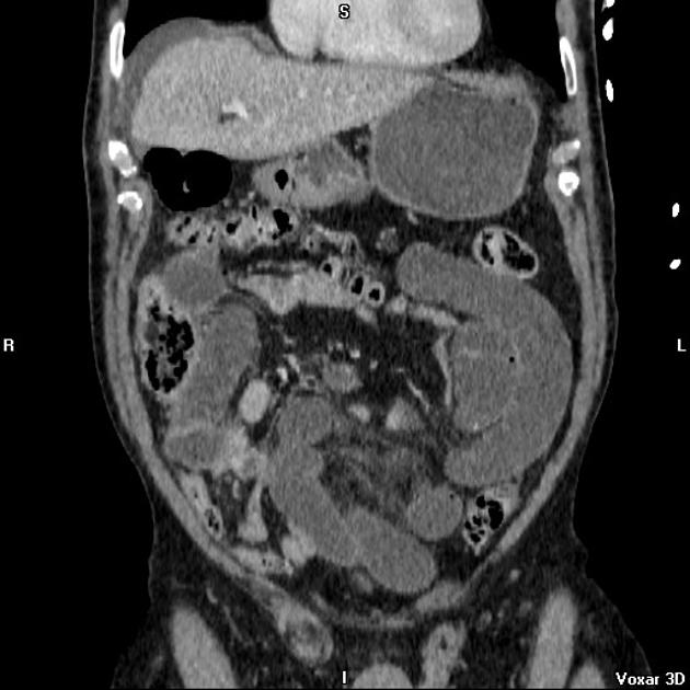 Closed loop obstruction Radiology Case Radiopaedia