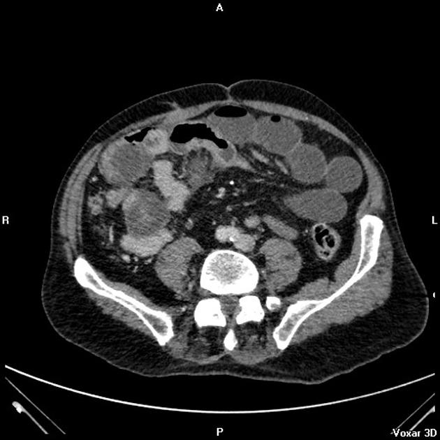 Closed loop obstruction Radiology Reference Article