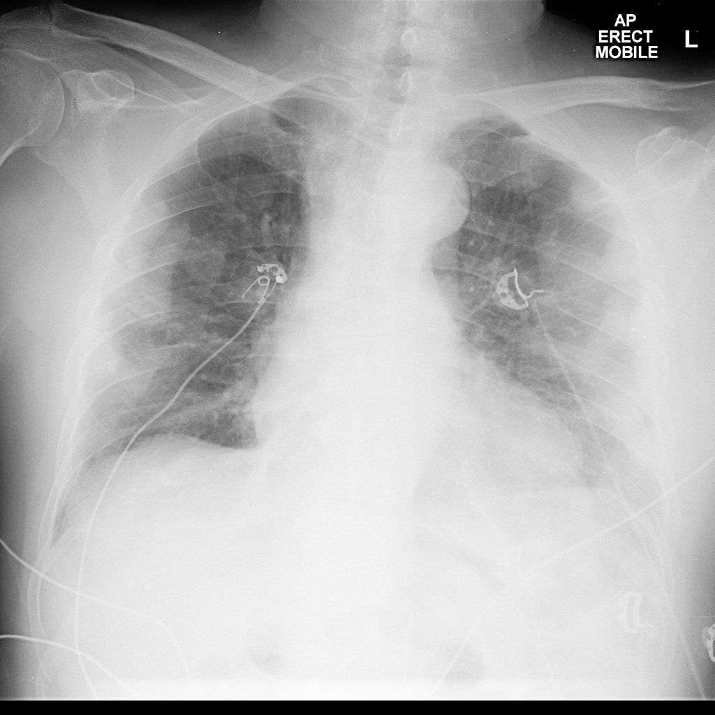 advanced stage 4 lung cancer survival rate