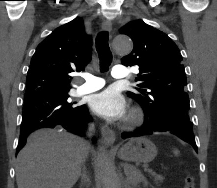 Pleural metastases | Image | Radiopaedia.org