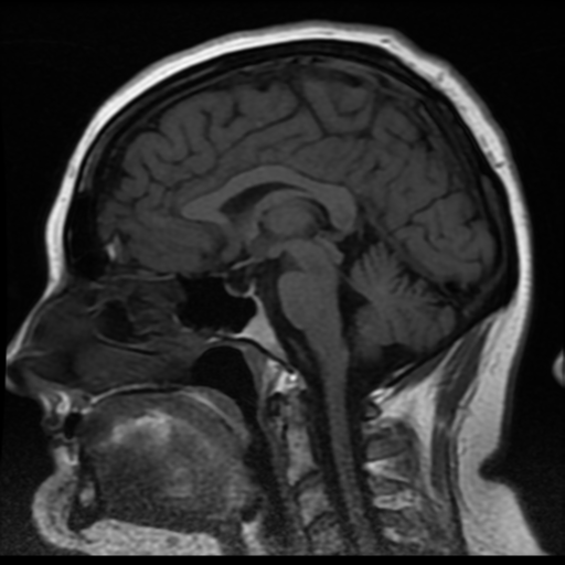 Neurofibromatosis type 2: bilateral vestibular schwannomas ...