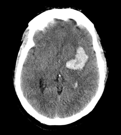 Cerebral dural arteriovenous fistula (DAVF) with intracerebral ...