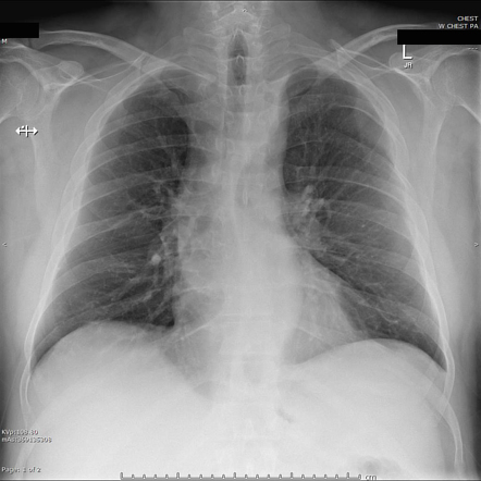 Repaired aortic coarctation | Radiology Case | Radiopaedia.org