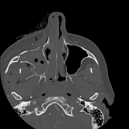 Complex craniofacial fractures | Image | Radiopaedia.org