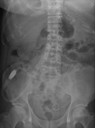 Medical devices in the abdomen and pelvis | Radiology Reference Article ...