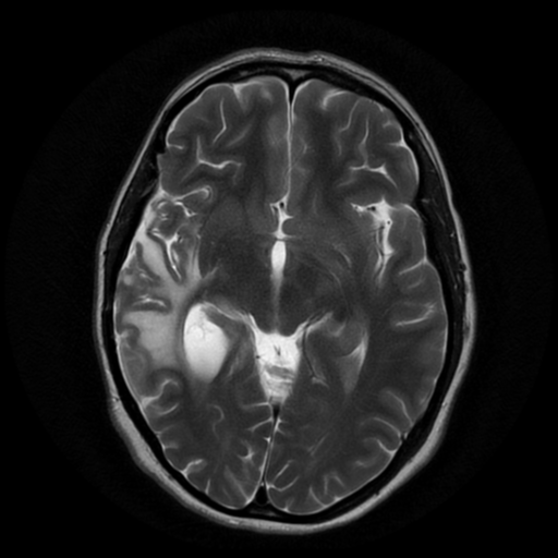 Glioblastoma IDH wild-type (pseudoprogression) | Image | Radiopaedia.org