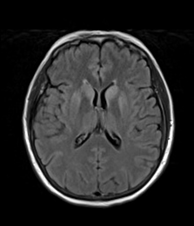 Creutzfeldt-Jakob disease | Image | Radiopaedia.org