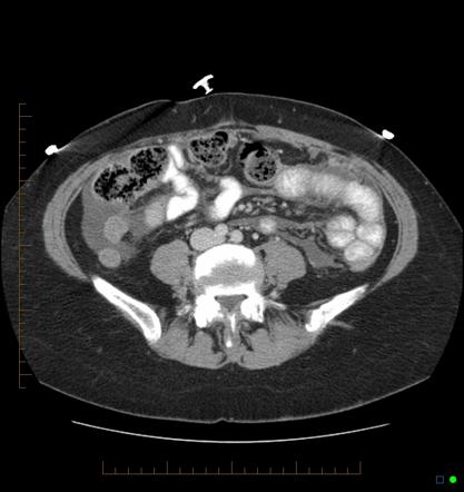 Peritoneal and bone metastases from breast cancer | Radiology Case |  Radiopaedia.org