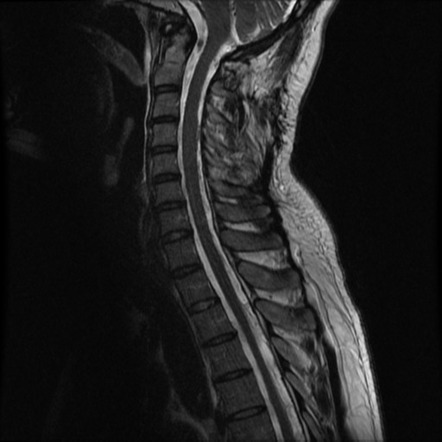 Extensive leptomeningeal seeding | Image | Radiopaedia.org