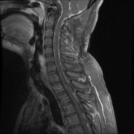 Leptomeningeal metastases | Radiology Reference Article | Radiopaedia.org