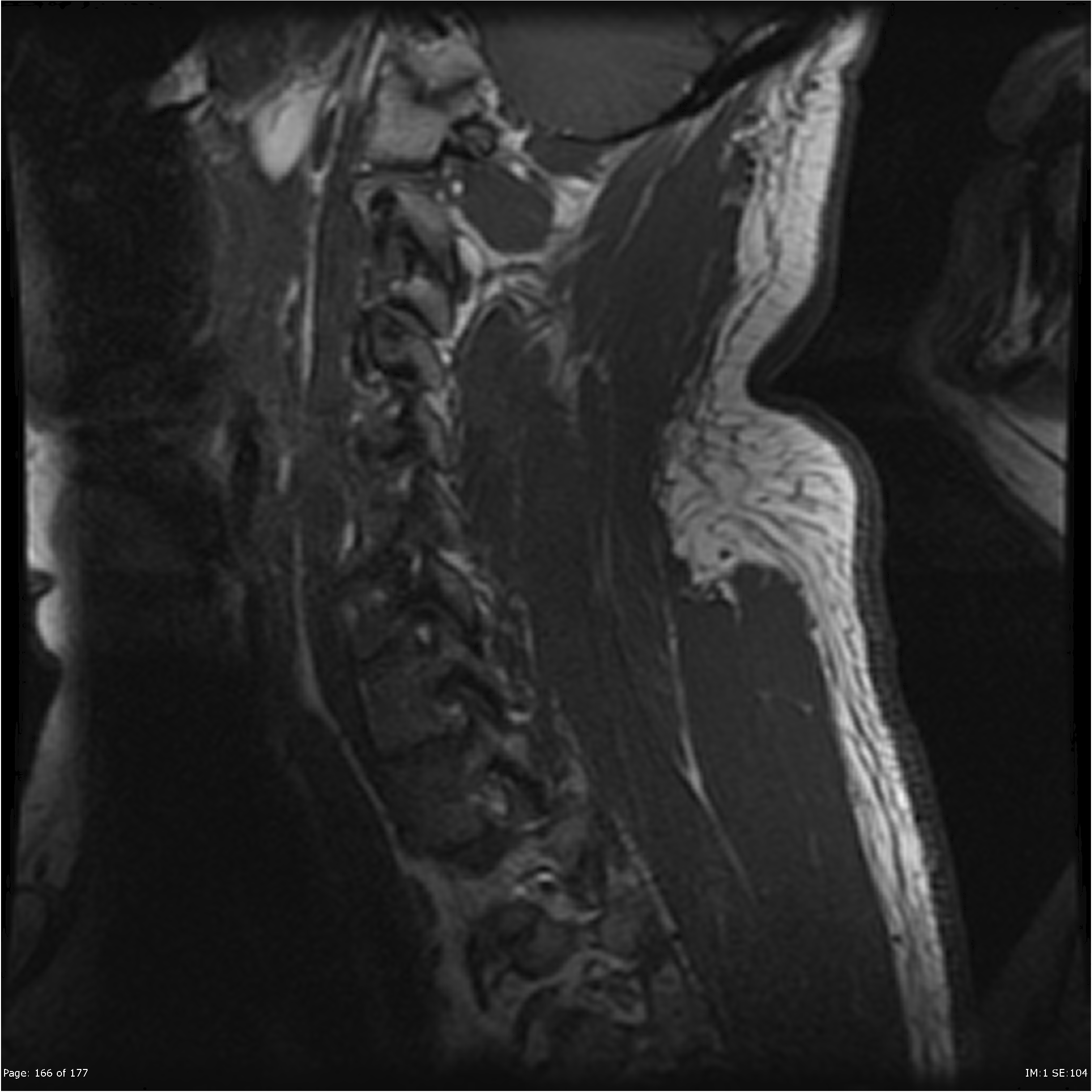 Intramedullary spinal cord abscess | Image | Radiopaedia.org