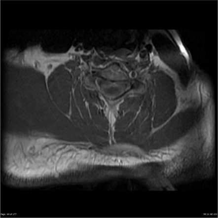 Pdf Cervical Spinal Cord Intramedullary Abscess Streptococcus