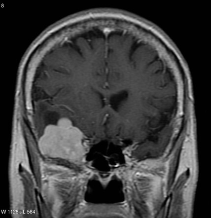 Meningioma with peritumoural cyst | Radiology Case | Radiopaedia.org