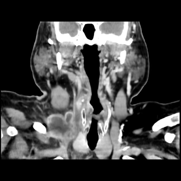 Supraclavicular lymph nodes Radiology Reference Article