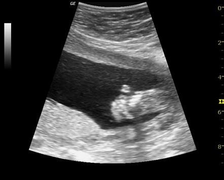 Patau syndrome physical characteristics