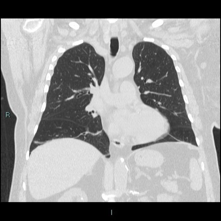 Endobronchial foreign body | Image | Radiopaedia.org