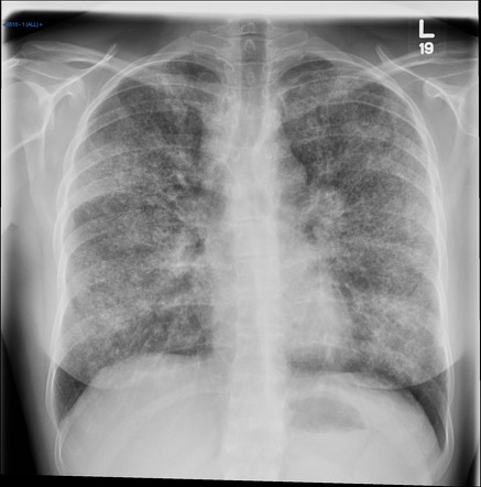 Sarcoidosis | Radiology Case | Radiopaedia.org