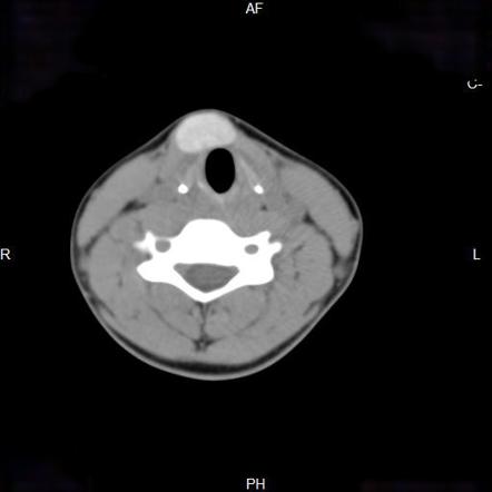 Ectopic thyroid | Radiology Reference Article | Radiopaedia.org