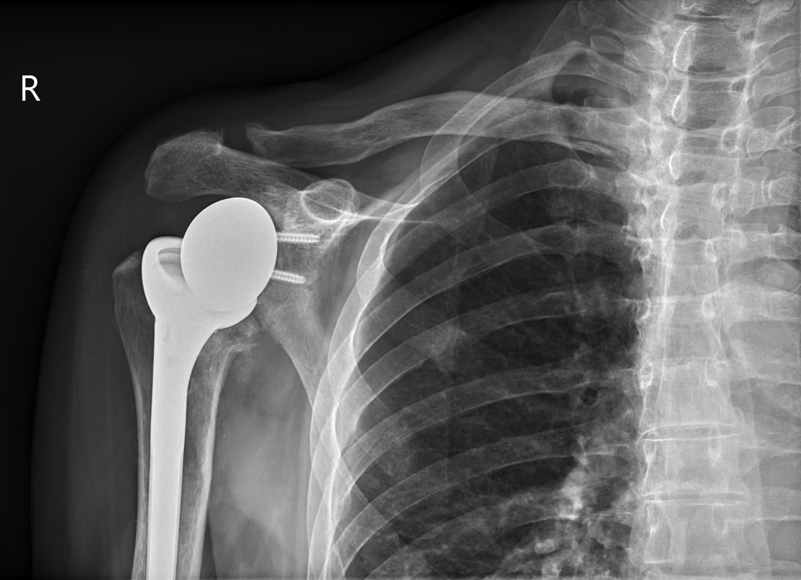 Shoulder Dislocation And Repair – NBKomputer