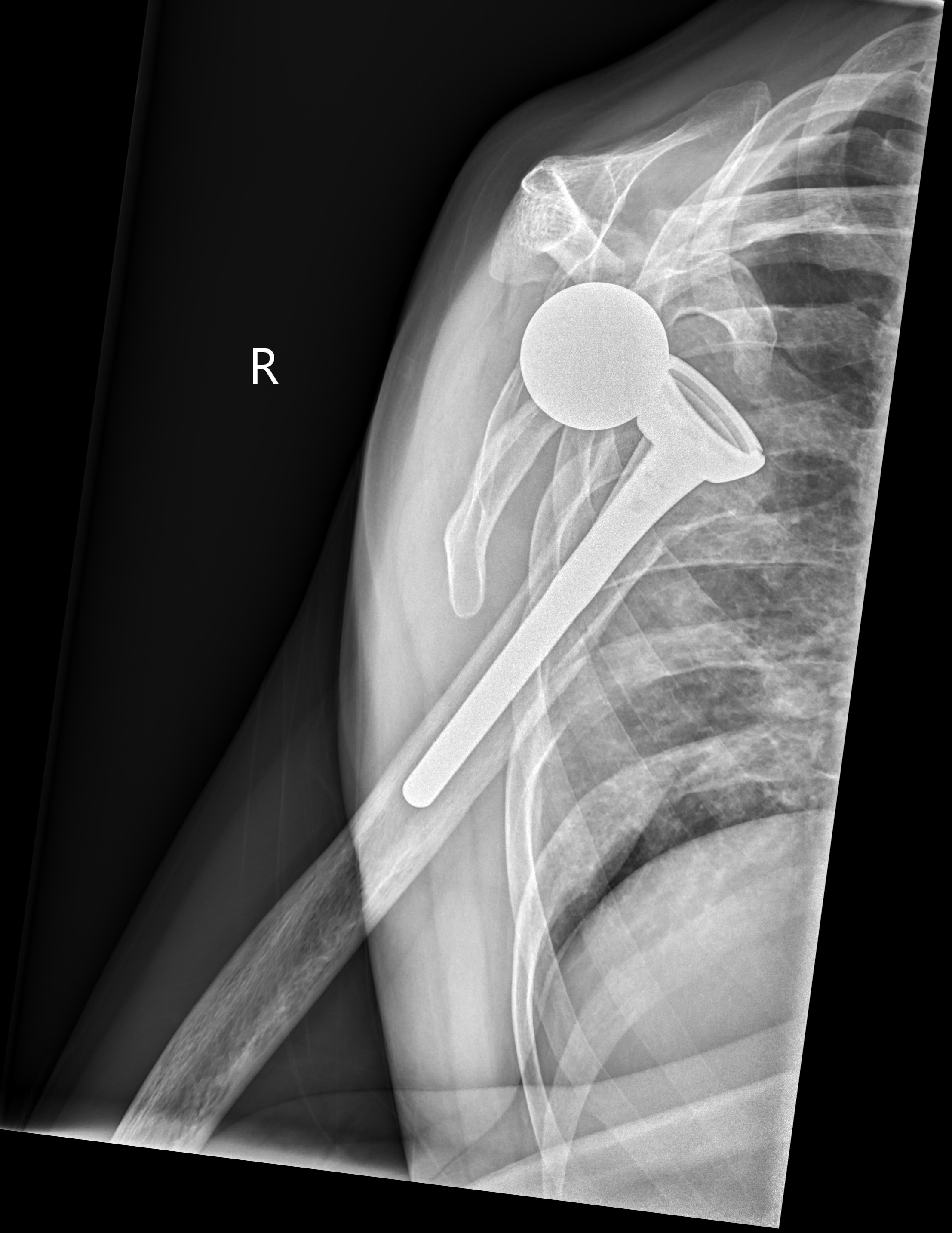 Reverse shoulder replacement dislocation | Image | Radiopaedia.org