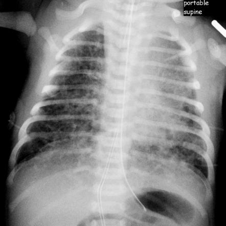 Neonatal Respiratory Distress Causes Radiology Reference Article Radiopaedia Org