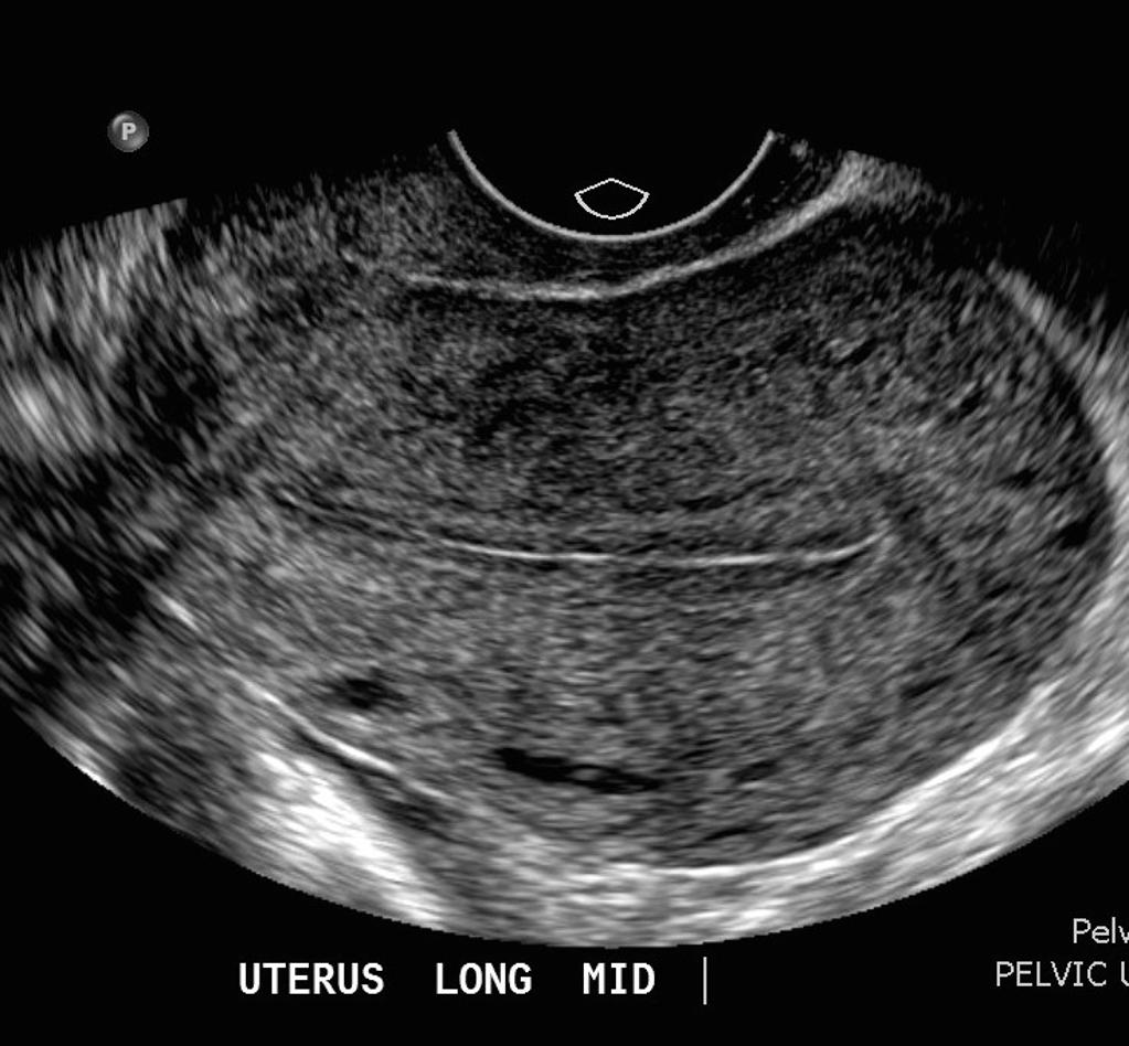 Тонкий эндометрий узи. Gynecologic Ultrasonography.