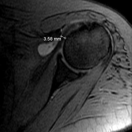 Subcoracoid impingement | Radiology Reference Article | Radiopaedia.org