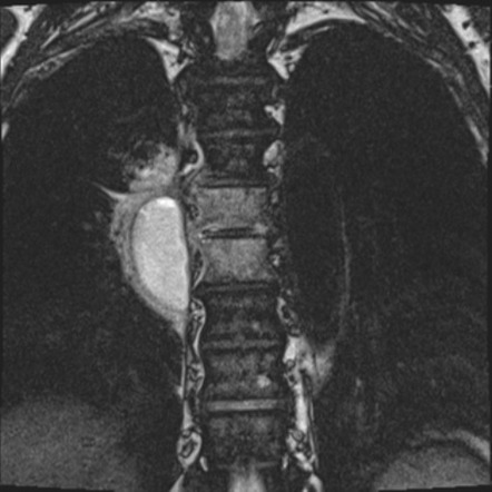 Thoracic paravertebral abscess and osteomyelitis | Radiology Case ...