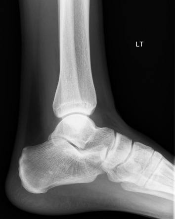 Ankle effusion | Radiology Case | Radiopaedia.org