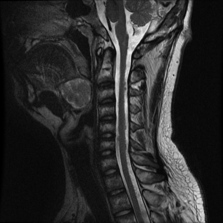 Neurofibromatosis type 2 | Image | Radiopaedia.org