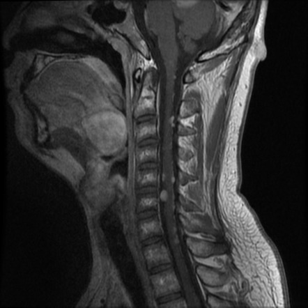 Neurofibromatosis type 2 | Image | Radiopaedia.org