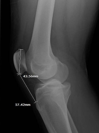 Patella alta | Image | Radiopaedia.org