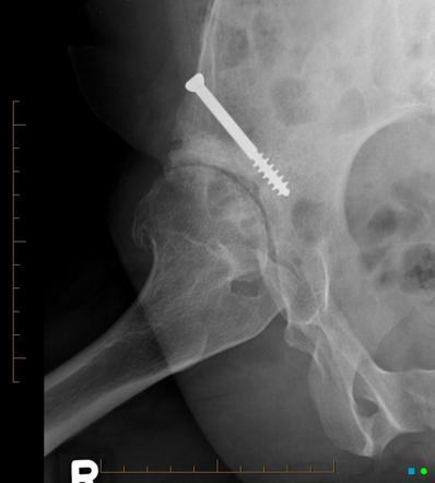 Chronic right hip dislocation - failed Staheli 