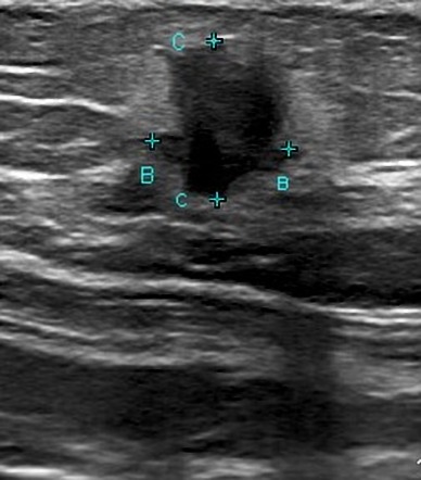 Male breast cancer - massive | Image | Radiopaedia.org