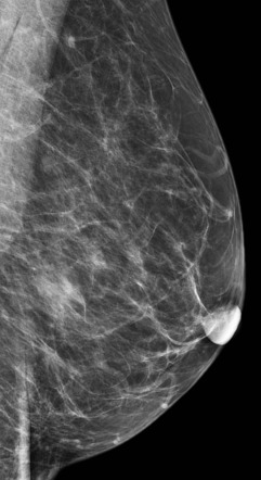 Lobular breast carcinoma | Radiology Reference Article | Radiopaedia.org