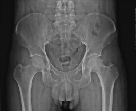 Avascular necrosis of the hip | Radiology Case | Radiopaedia.org