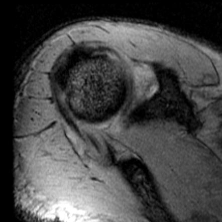 Adhesive Capsulitis: Shoulder | Radiology Case | Radiopaedia.org