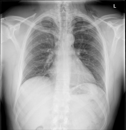 Pneumomediastinum | Radiology Case | Radiopaedia.org