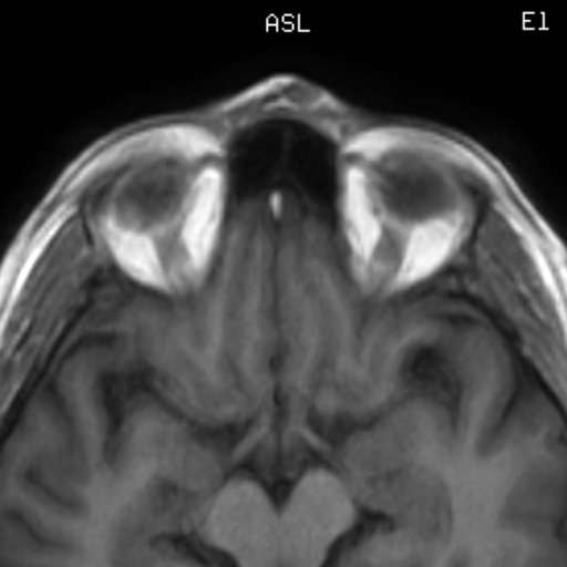 Nasal Dermoid Cyst Image 2809